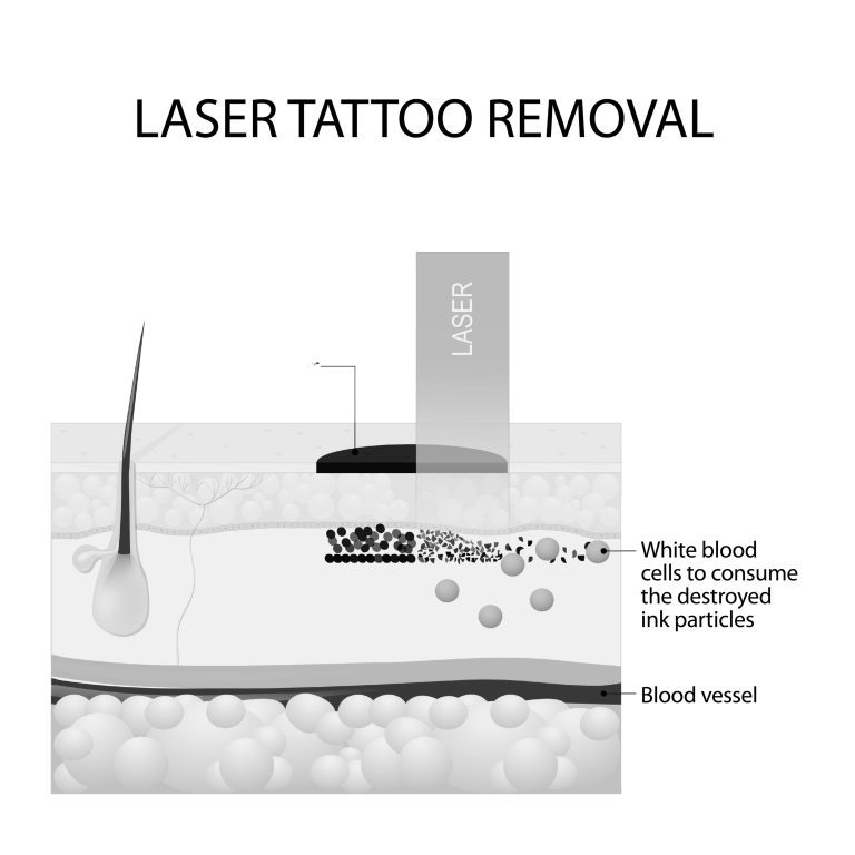 One application of laser optics for skin care is breaking up ink particles for tattoo removal.
